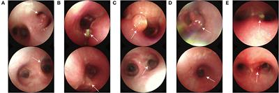 Efficacy and safety of CO2 cryotherapy in the treatment of infants with tracheobronchial tuberculosis